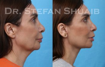 images before and after facial rejuvenation procedure