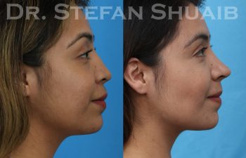 female patient before and after revision rhinoplasty procedure