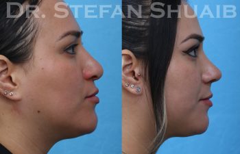 female patient before and after revision rhinoplasty procedure