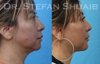 female patient before and after facial rejuvenation procedure
