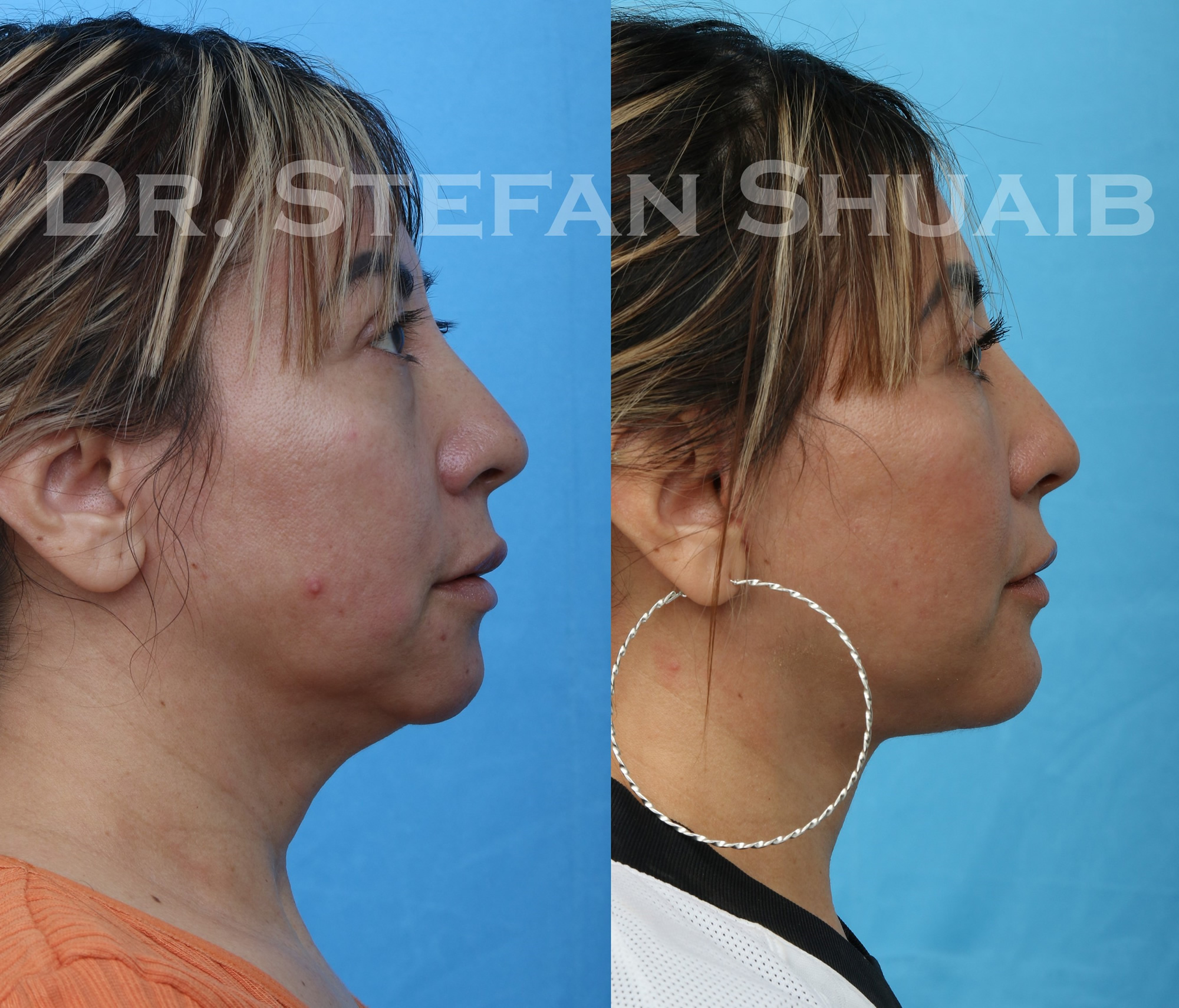 female patient before and after facial rejuvenation procedure