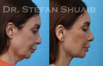 images before and after facial rejuvenation procedure