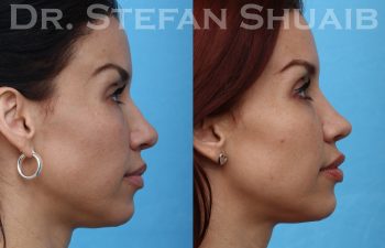 female patient before and after rhinoplasty procedure