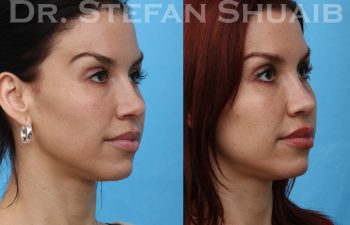 female patient before and after rhinoplasty procedure