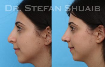 female patient before and after rhinoplasty procedure