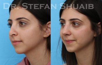 female patient before and after rhinoplasty procedure