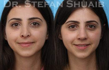 female patient before and after rhinoplasty procedure