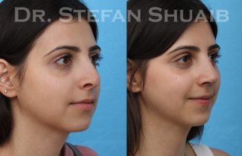 female patient before and after rhinoplasty procedure