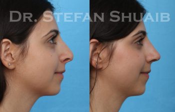 female patient before and after rhinoplasty procedure