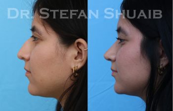 female patient before and after rhinoplasty procedure