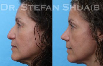 female patient before and after rhinoplasty procedure