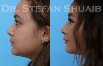 female patient before and after rhinoplasty procedure