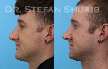male patient before and after rhinoplasty procedure
