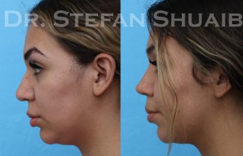 female patient before and after rhinoplasty procedure