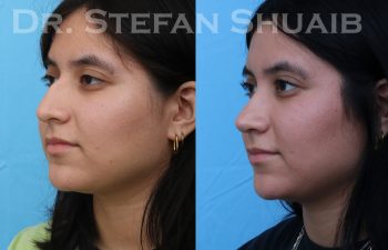 female patient before and after rhinoplasty procedure