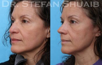 female patient before and after rhinoplasty procedure