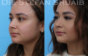 female patient before and after rhinoplasty procedure