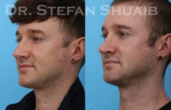 male patient before and after rhinoplasty procedure