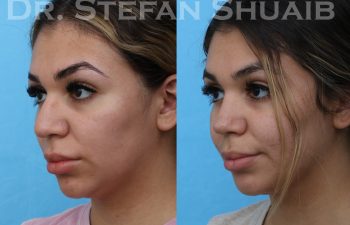 female patient before and after rhinoplasty procedure