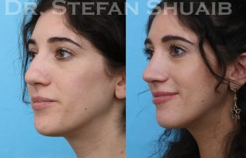 female patient before and after rhinoplasty procedure