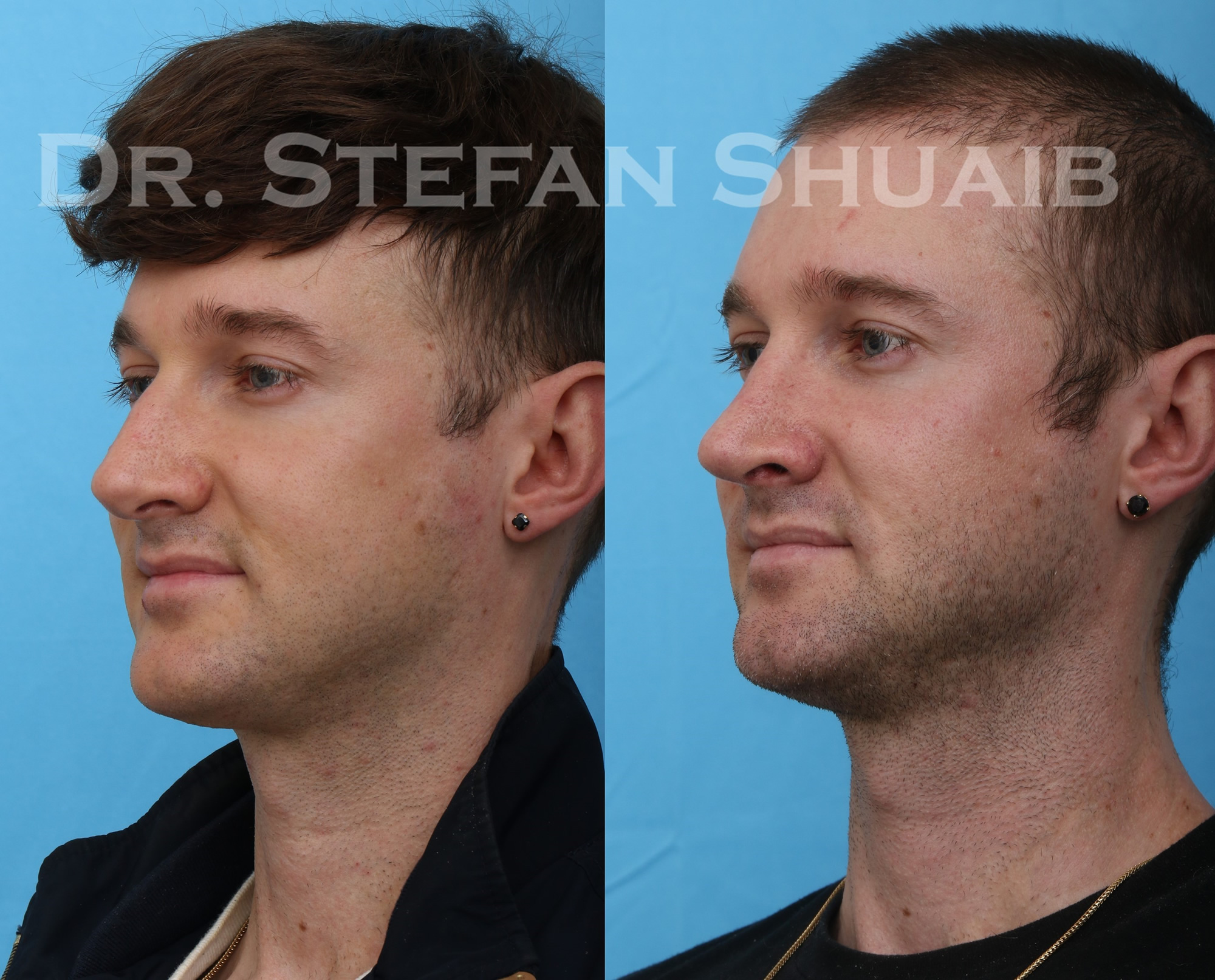 male patient before and after rhinoplasty procedure