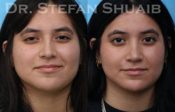 female patient before and after rhinoplasty procedure