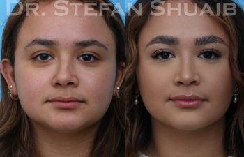 female patient before and after rhinoplasty procedure