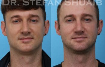 male patient before and after rhinoplasty procedure