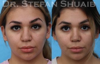 female patient before and after rhinoplasty procedure