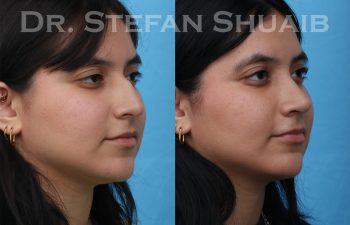 female patient before and after rhinoplasty procedure