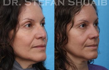 female patient before and after rhinoplasty procedure