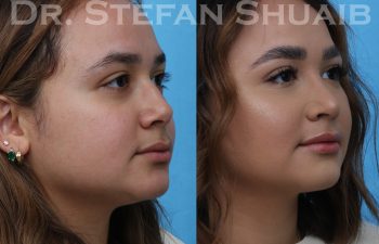 female patient before and after rhinoplasty procedure