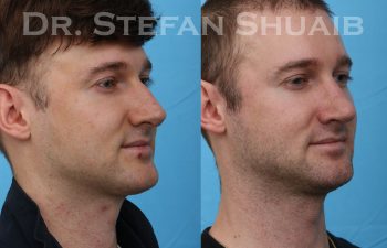 male patient before and after rhinoplasty procedure