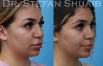 female patient before and after rhinoplasty procedure