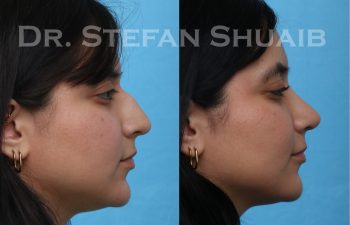 female patient before and after rhinoplasty procedure