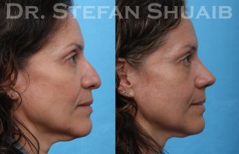 female patient before and after rhinoplasty procedure