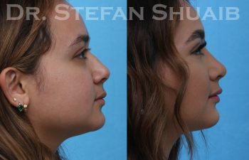 female patient before and after rhinoplasty procedure