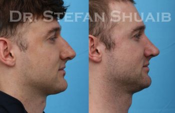 male patient before and after rhinoplasty procedure