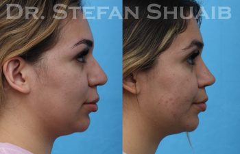 female patient before and after rhinoplasty procedure