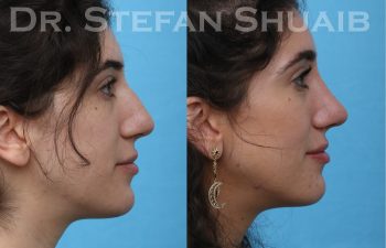 female patient before and after rhinoplasty procedure