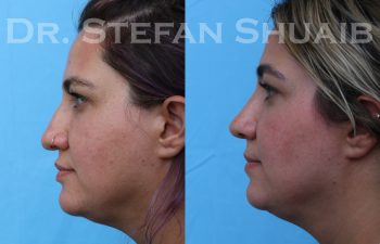 female patient before and after rhinoplasty procedure