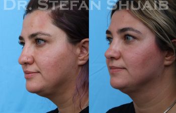 female patient before and after rhinoplasty procedure