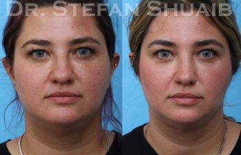 female patient before and after rhinoplasty procedure