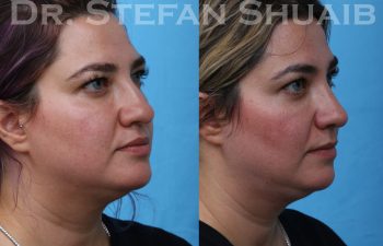 female patient before and after rhinoplasty procedure