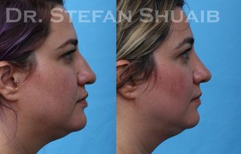 female patient before and after rhinoplasty procedure