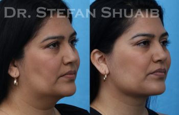 female patient before and after facial rejuvenation