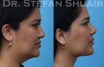 female patient before and after facial rejuvenation