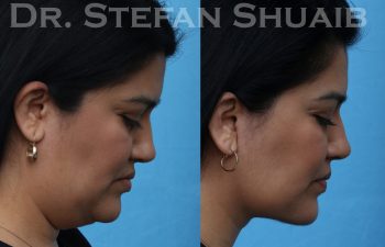 female patient before and after facial rejuvenation