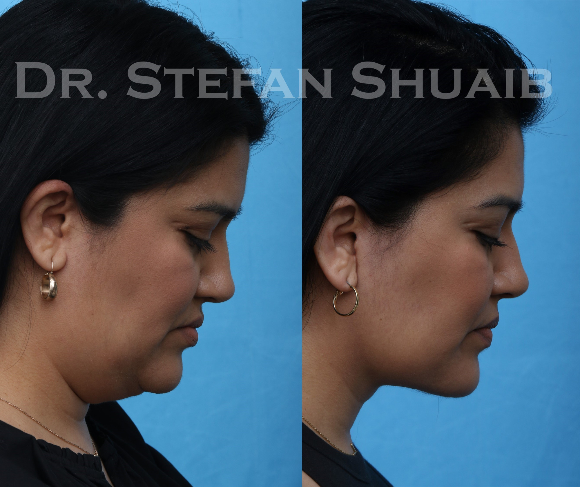 female patient before and after facial rejuvenation