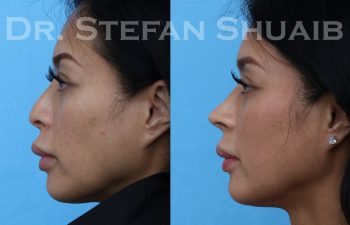 female patient before and after rhinoplasty procedure